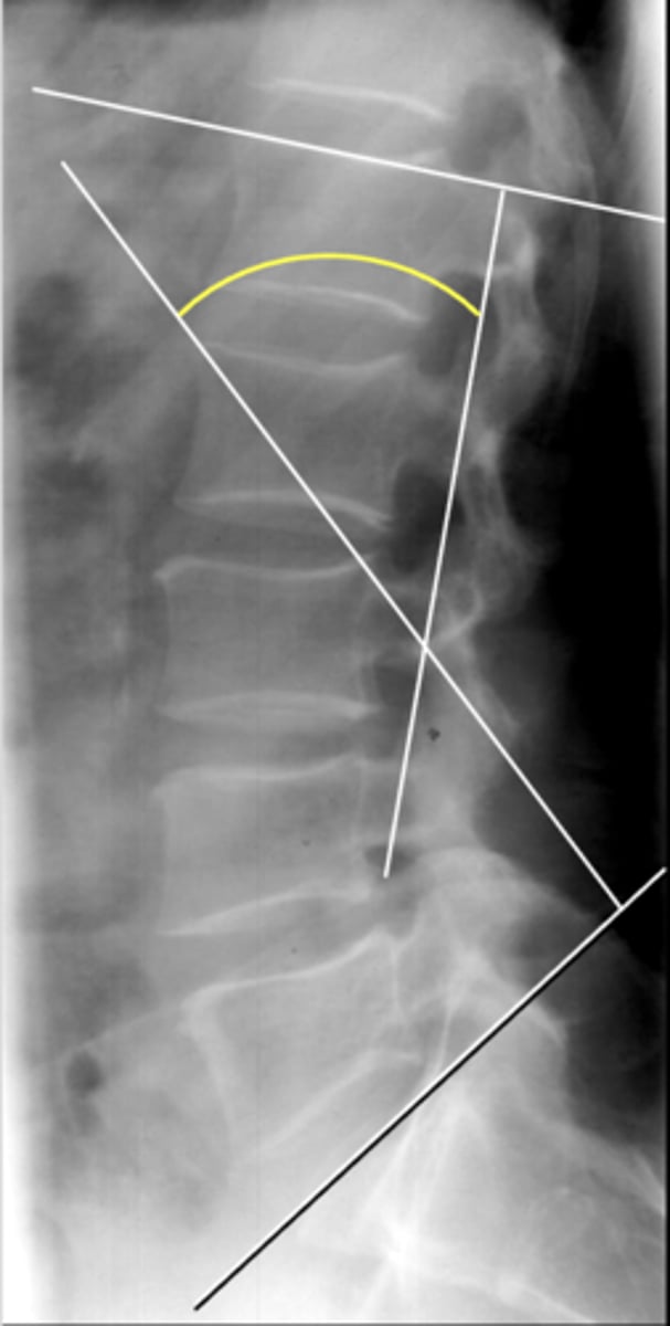 <p>How is the lumbar lordosis measurement line drawn?</p>