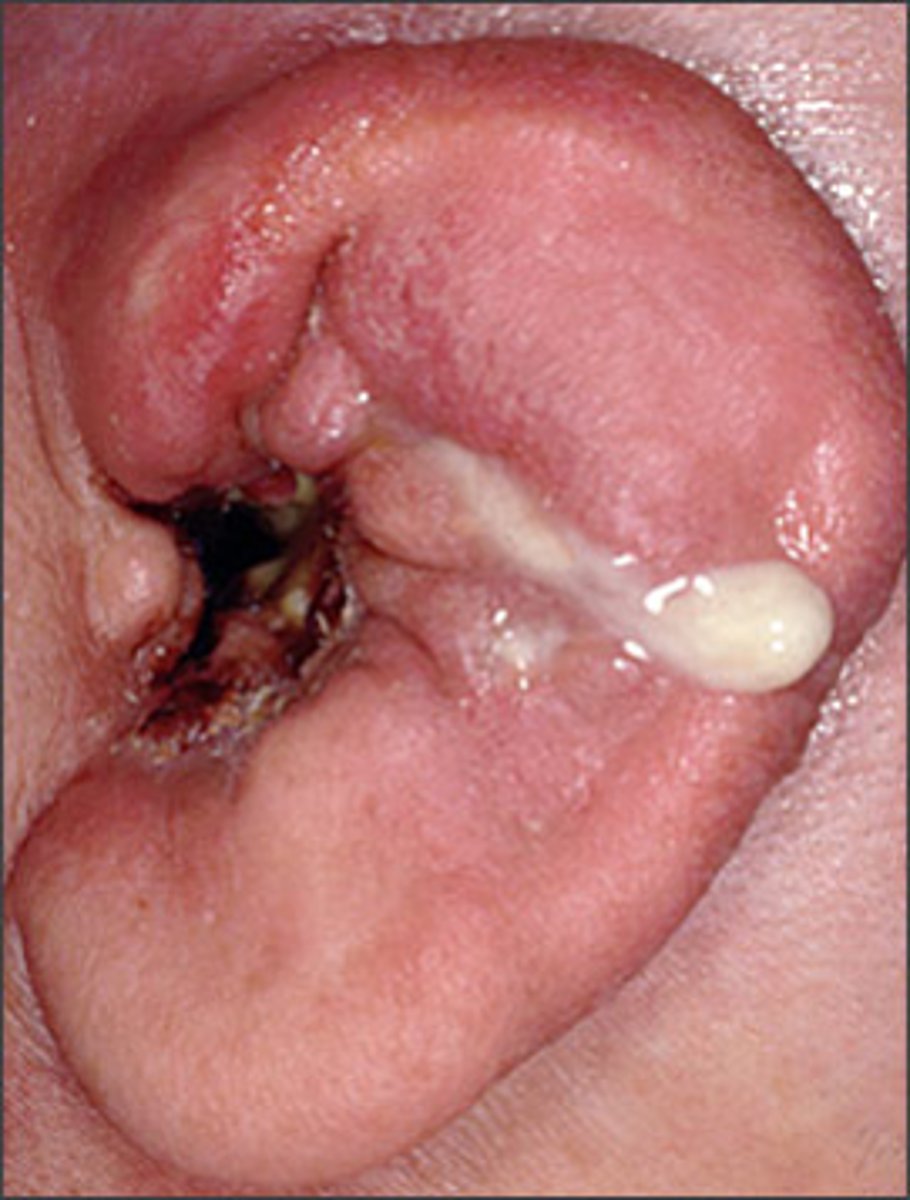 <p>infection occurring in the skin of EAC, caused by allergic reactions to ear plugs, hearing aid molds, soap, pool water<br>symptoms:<br>-ear pain (otalgia)<br>-ear drainage (otorrhea)<br>-TM can become inflamed<br>-itching sensations</p>