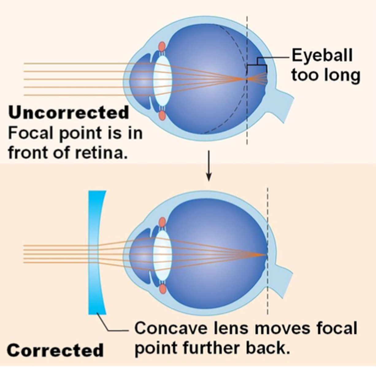 <p>- A defect of the eye where distant objects appear out of focus - This is due to the convergence of light rays in front of the retina<br>- The person's eyeball is too long or the lens is too strong</p>