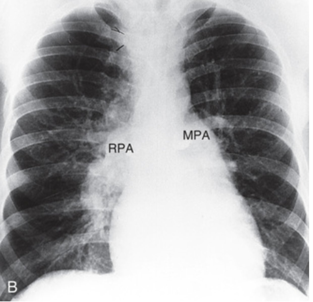 <p>- Enlargement of both the left and right main pulmonary arteries is present</p>