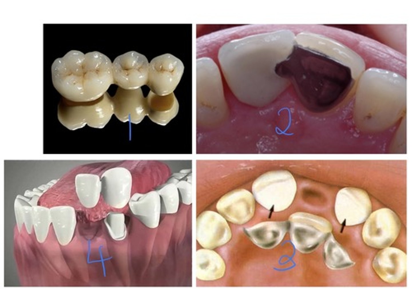 <p>- Fixed restoration</p><p>- Minimal preparation</p><p>- Good aesthetic</p>