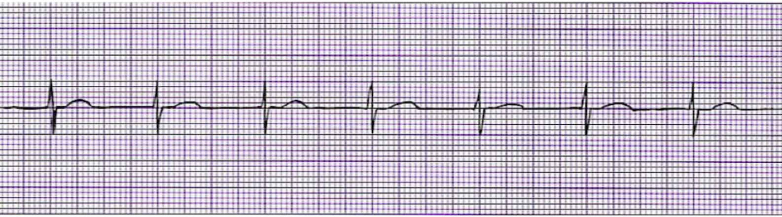 <p>What is this rhythm?</p>