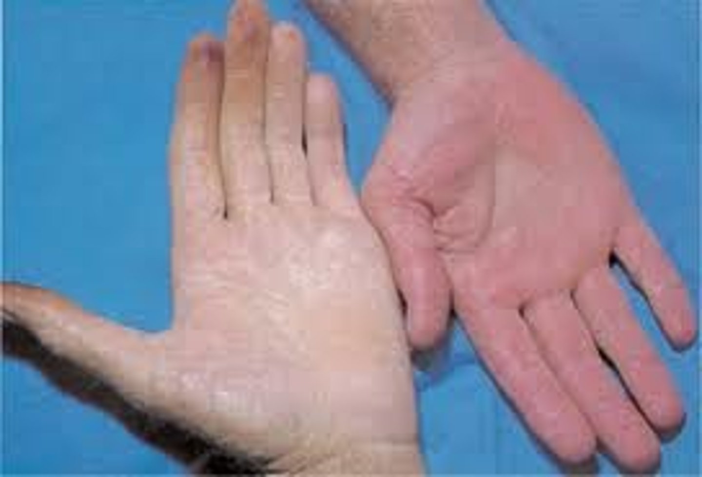 <p>may indicate fear, anger, emotional stress, anemia, and low blood pressure</p>