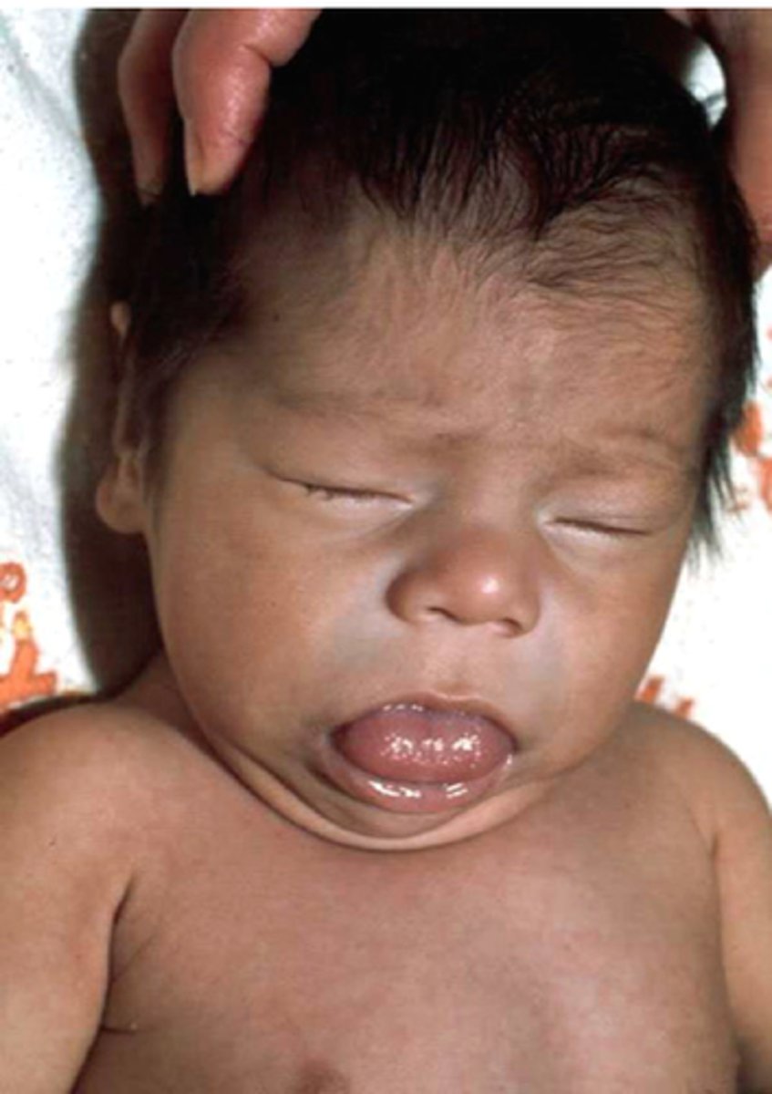 <p>congenital hypothyroidism (cretinism)</p>