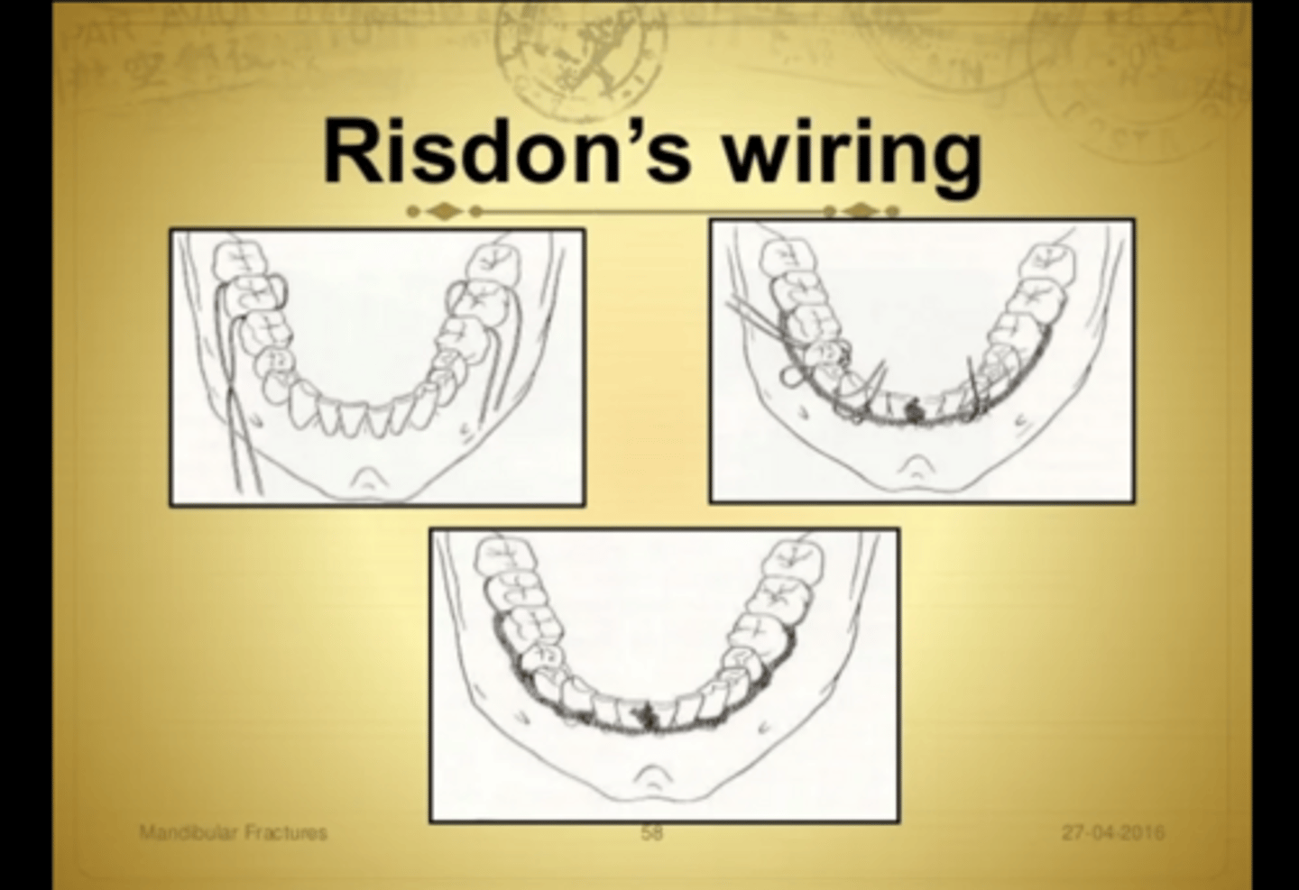 <p>0.4mm thick, 25cm long wire (2 wires)</p><p>- 2 wires twisted around distal molars on each side</p><p>- ends of each wire twisted buccally</p><p>- both wires connected at midline = buccal base wire</p><p>tie the ligatures in the cervical region of each tooth to anchor each tooth to buccal base</p><p>- hooks at lengths of 6-8mm can be placed for IMF</p>