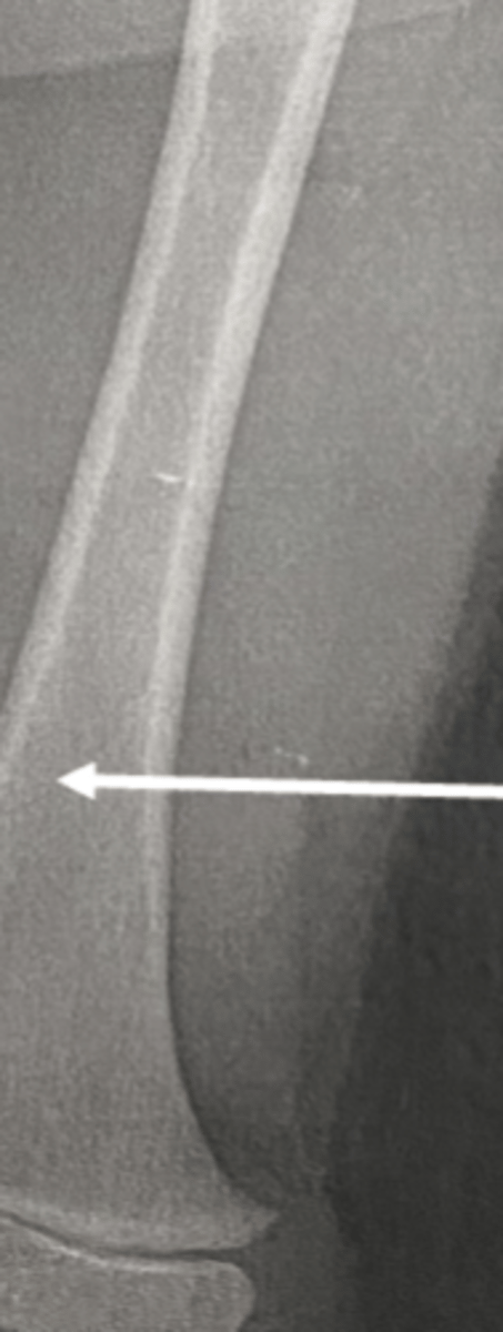 <p>femur</p>