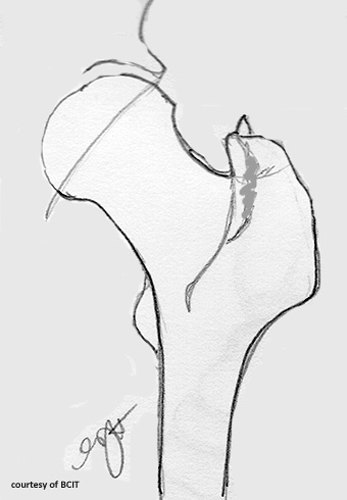 <p>Sudden, forceful muscle contraction (e.g., sports or trauma).</p>