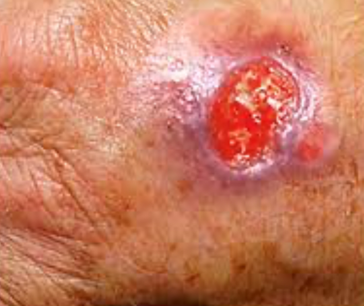 <p>Ulcer</p>