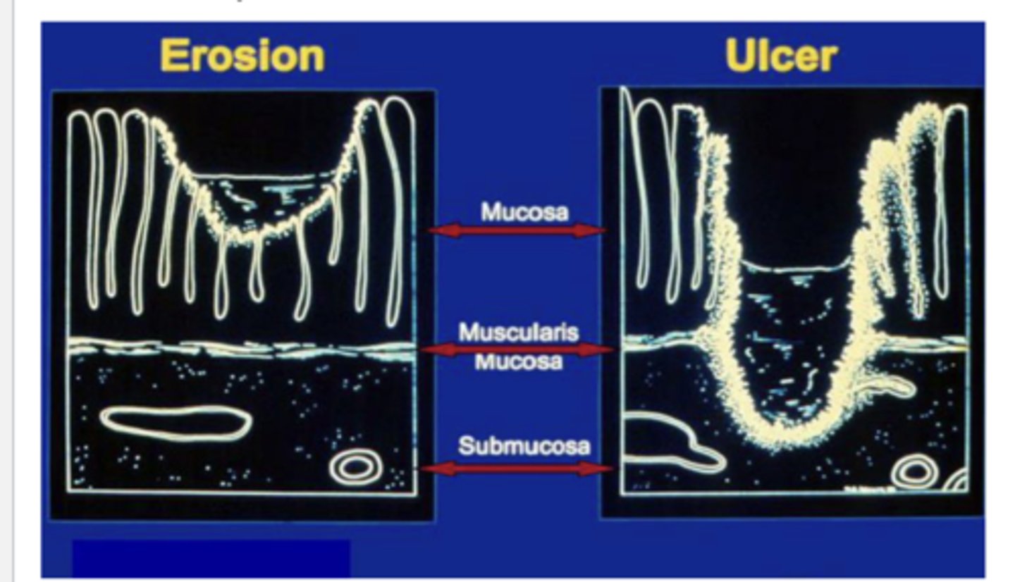 <p>injury to the lining of the stomach/duodenum that penetrates through the muscularis mucosa of stomach/duodenum</p>