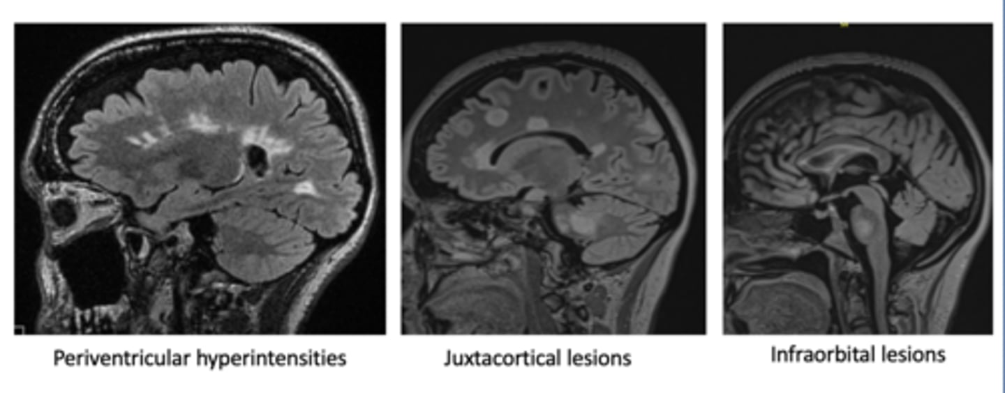 <p>Periventricular (Dawson's Fingers), Juxtacortical, and Infraorbital lesions</p>