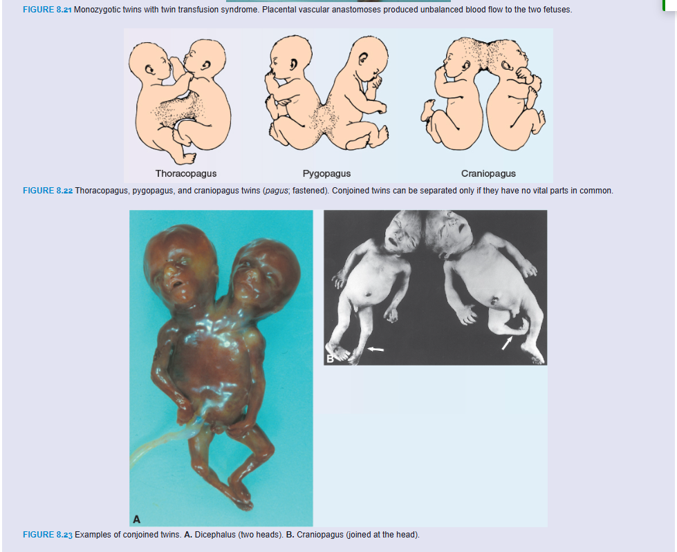 <p>Another problem leading to increased mortality among twins is the twin–twin transfusion syndrome, which occurs in 15% of monochorionic monozygotic pregnancies. In this condition, placental vascular anastomoses, which occur in a balanced arrangement in most monochorionic placentas, are formed such that transfer of blood from one twin (donor/pump) to the other (recipient) occurs. As a result, the donor twin develops anemia, hypovolemia (decreased blood volume), and growth restriction, while the recipient twin develops polycythemia (excessive numbers of red blood cells) and hypervolemia that cause cardiac hypertrophy and congestive heart failure (Fig. 8.21). The outcome is poor, with the death of both twins occurring in 50% to 70% of cases.</p><p>At later stages of development, partial splitting of the primitive node and streak may result in formation of conjoined twins. These twins are classified according to the nature and degree of their union (Figs. 8.22 and 8.23). Occasionally, monozygotic twins are connected only by a common skin bridge or by a common liver bridge. The type of twins formed depends on when and to what extent abnormalities of the node and streak occurred. Misexpression of genes, such as GOOSECOID, may also result in conjoined twins. Many conjoined twins have survived, including the most famous pair, Chang and Eng, who were joined at the abdomen and who traveled to England and the United States on exhibitions in the mid-1800s. Finally settling in North Carolina, they farmed and fathered 21 children with their two wives.</p><p>In brother–sister pairs of dizygotic twins, testosterone from the male twin can affect development of the female. Thus, females in such pairs tend to have square jaws, larger teeth, perform better on spatial ability tests and have better ball skills than most girls. They are 15% less likely to get married and they have fertility problems, producing 25% fewer children.</p>