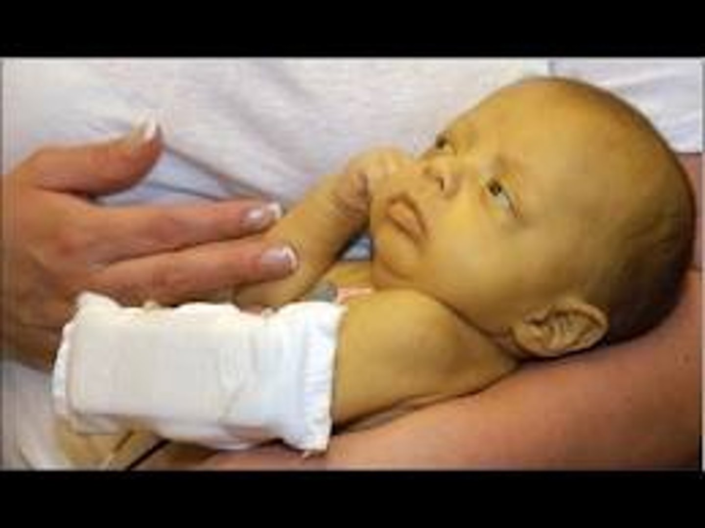 <p>Physiologic jaundice occurs during days 2-5 of life, progresses from head to toe, and breastfeeding is a common cause</p>