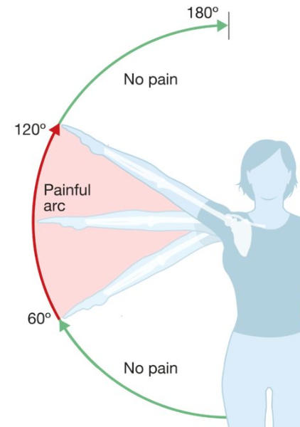 <p>Painful arc </p>