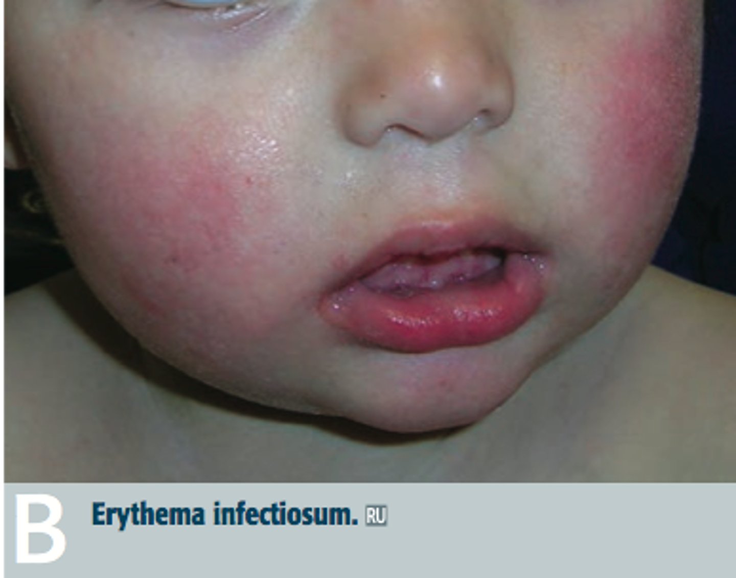 <p>Erythema Infectiosum (Fifth Disease) - caused by Parvovirus B19</p>