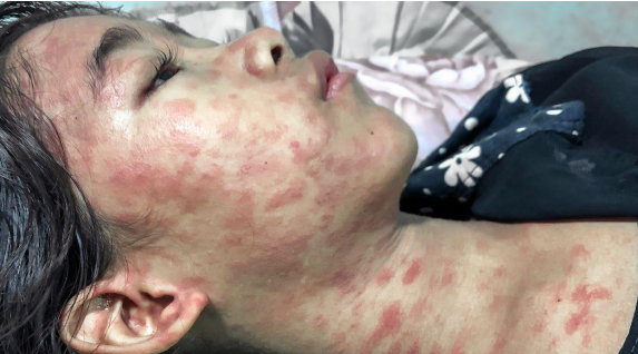 <p>Chikungunya Virus Disease</p>