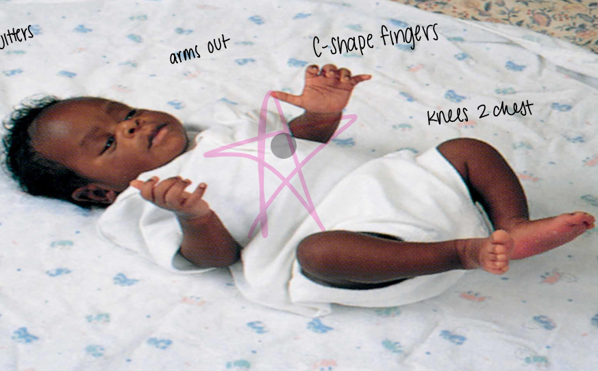 <p><span>an involuntary reaction in newborns where they suddenly extend their arms and legs, spread their fingers, and then quickly bring their arms and legs back to their body, often accompanied by a cry</span></p>