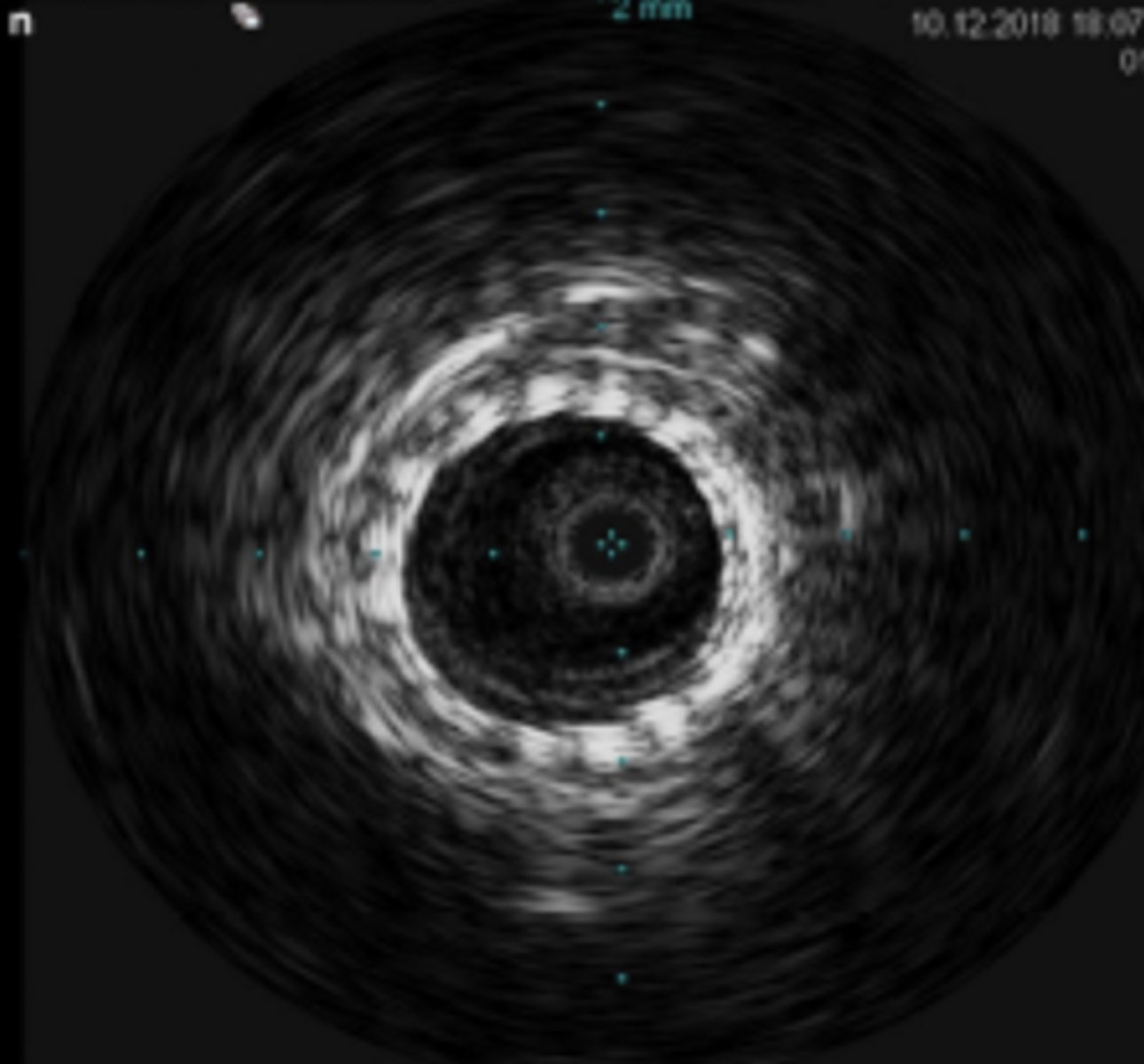<p>Imaging within blood vessels</p><p>Femoral V access in cath lab</p><p>Specialized catheter with mini transducer at the tip - produces multi-element electronic (annular) arrays</p>