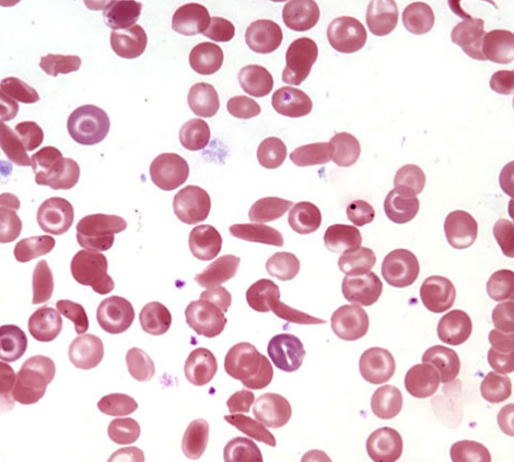 <p>Identify the disease</p>