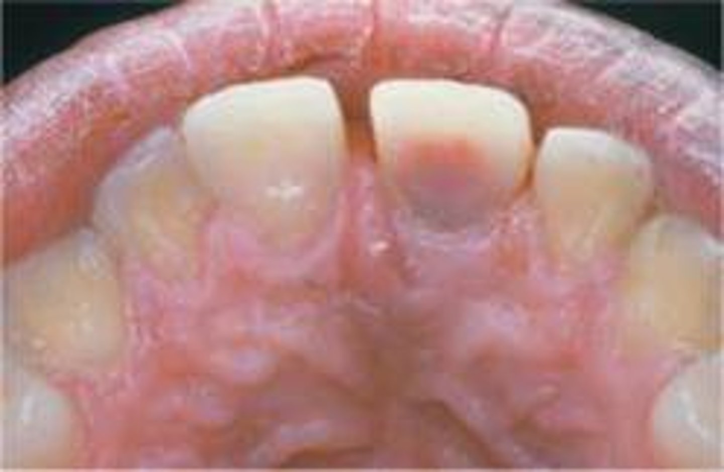 <p>Pink tooth</p>