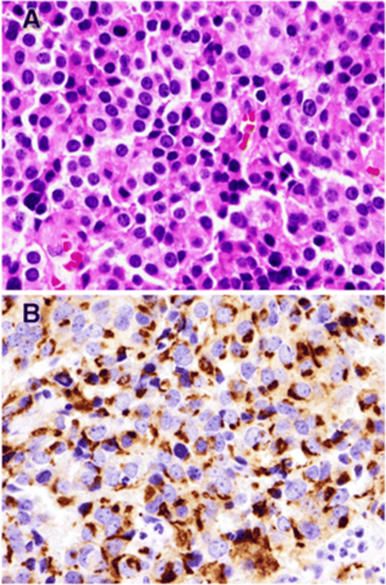 <p>Define Adenoma:</p><p>FIRST MC type of FUNCTIONAL PitNET (30-50%)</p><p>-Path: Secrete Excess PRL --&gt; Hyperprolactinemia</p><p>==&gt; Stimulates LACTATION in breast tissue</p><p>==&gt; Inhibits GnRH Synthesis/Release ==&gt; Inhibits OVULATION in Females/SPERMATOGENESIS in Males</p><p>-Sx/PE:</p><p>&gt; Galactorrhea (More PRL)</p><p>&gt; Amenorrhea (Less GnRH --&gt; Less FSH/LH --&gt; Less gonadal fxn)</p><p>&gt; Lower Libido (Less GnRH --&gt; Less FSH/LH --&gt; Less gonadal fxn)</p><p>-Dx: (Histo)</p><p>&gt; Sparsely Granulated</p><p>&gt; Uniform medium-sized cells w/ pale eosinophilic cytoplasm of central nuclei</p><p>&gt; Perinuclear, Golgi-like Immunoreactivity</p>