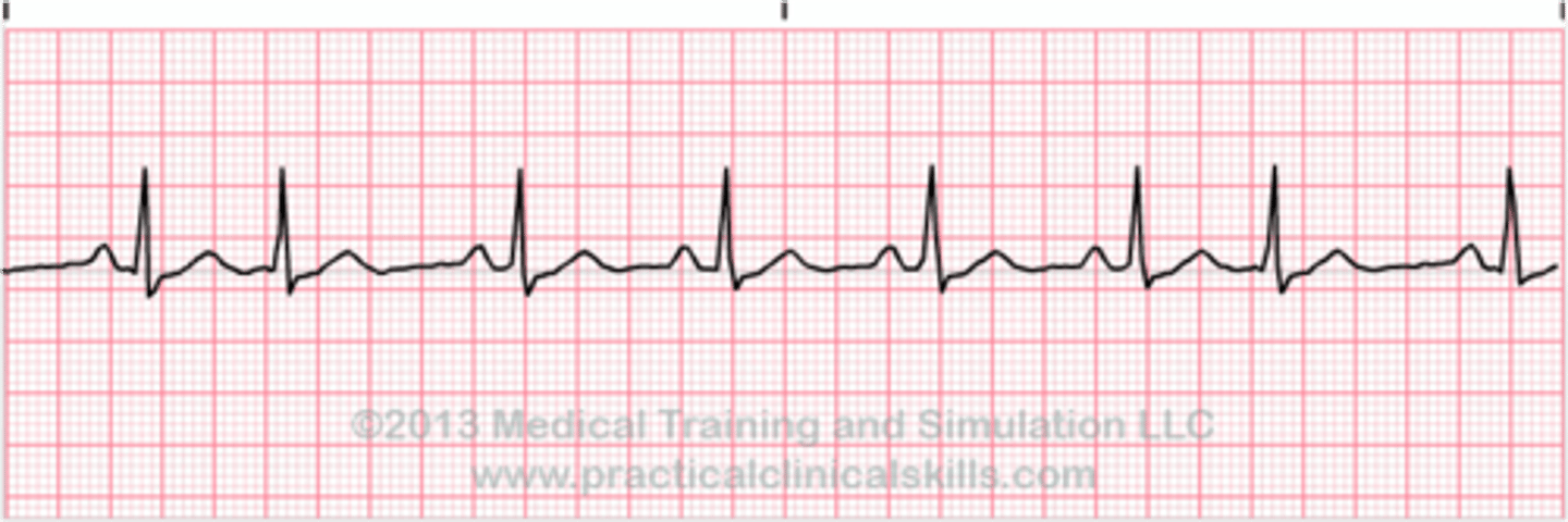 <p>Which Arrythmia is this?</p>