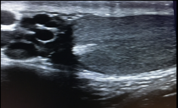 <p>Varicocele</p>