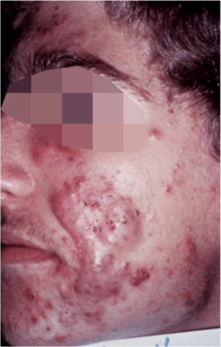 <p>cystic acne. cysts with comedones, papules, pustules and inflammation are present. scar formation from tissue damage is common</p>