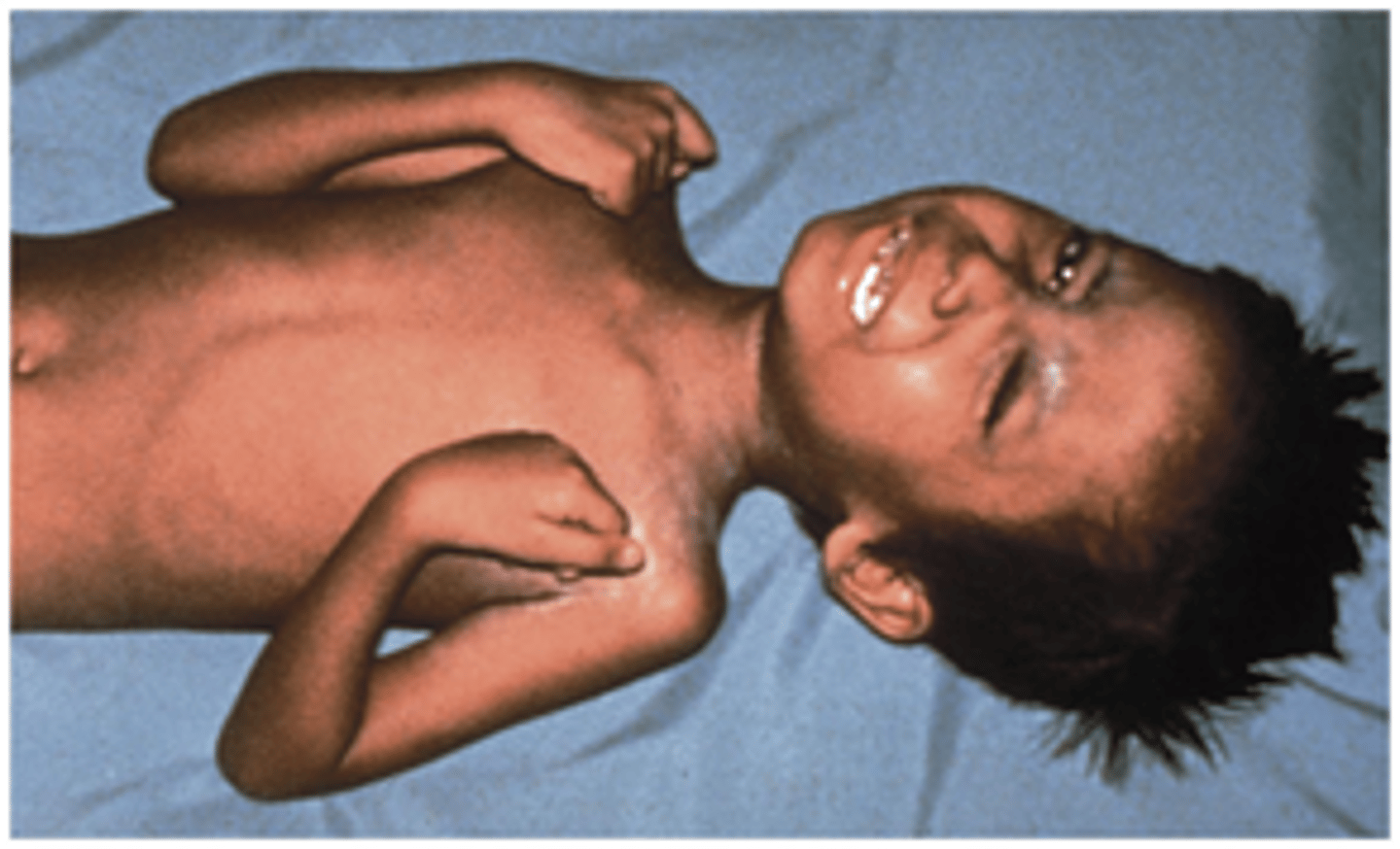 <p>1. Trismus (lockjaw)<br>2. Sustained muscle contraction<br>3. Facial muscle involvement</p>