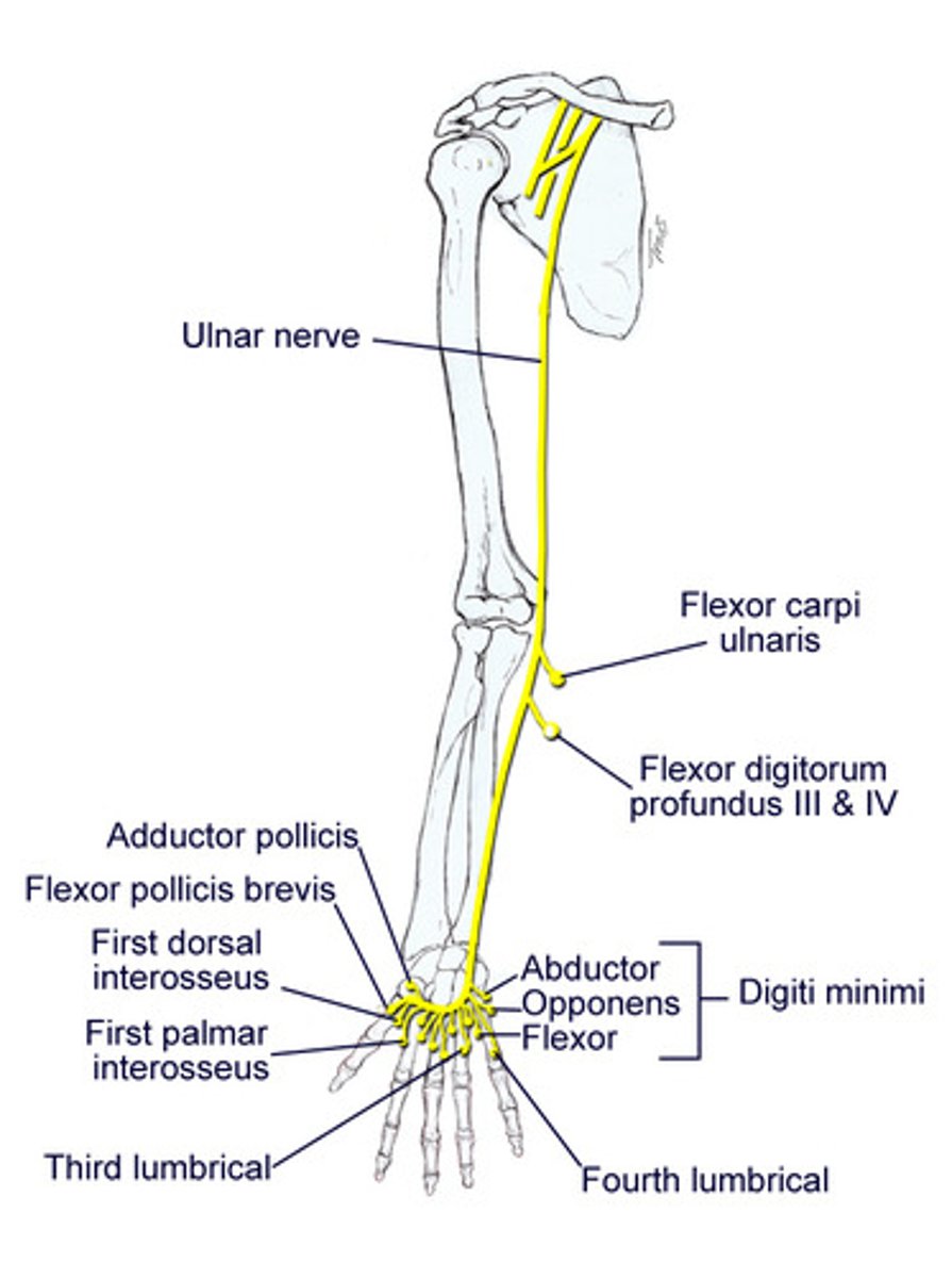 <p>Spinal Roots: C8-T1</p><p>Cause of Injury:</p><p>- proximal lesion = fracture of medial epicondyle of humerus (funny bone)</p><p>- distal lesion = fractured hook of hamate</p><p>Presentation:</p><p>- ulnar CLAW on digit extension (finger flexors and abductors)</p><p>- radial deviation upon flexion (proximal lesion)</p><p>- loss of wrist flexion, flexion of medial fingers, abduction and adduction of fingers (interossei) , actions of medial 2 lumbrical muscles</p><p>- loss of sensation over medial 1.4 fingers including HYPOTHENAR eminence</p>