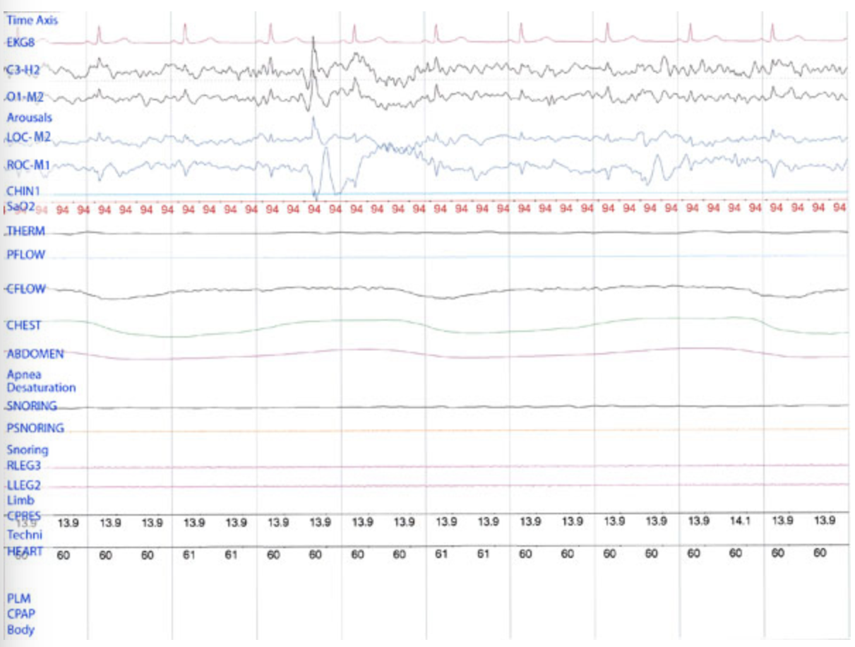 <p>While scoring a sleep study of an adult, a sleep disorders specialist observes the following 10 second recording. The specialist should </p>