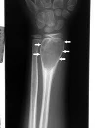 <p>is a true fluid-filled cyst with a wall of fibrous tissue, which most often occurs in the proximal humerus or femur at \n the metaphysis. \n It is asymptomatic. \n It is often discovered either incidentally or after pathologic fracture.</p>