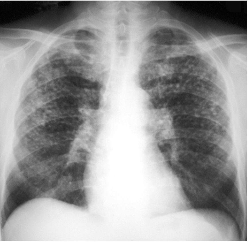 <p>What form of silicosis is normally asymptomatic with no negative functional effects</p>