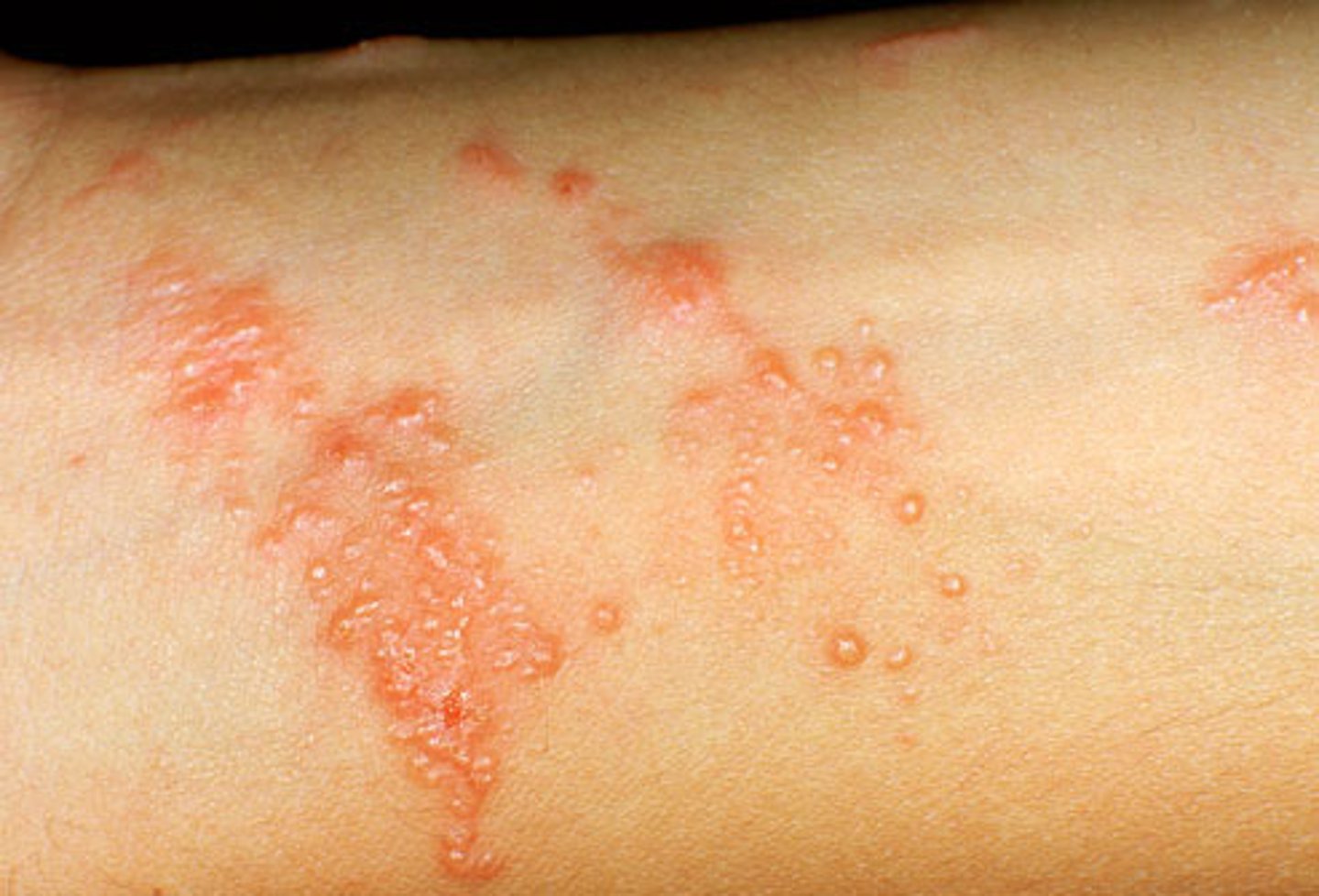 <p>C. Poison ivy</p>
