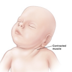<p>postural deformity of neck (lateral neck flexion and neck rotation)</p><p>contracted muscle appears like a mass</p>