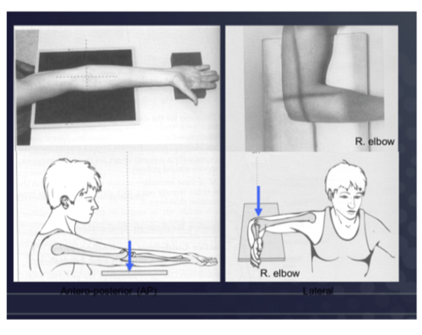<p>Direction of the x-ray beam</p>