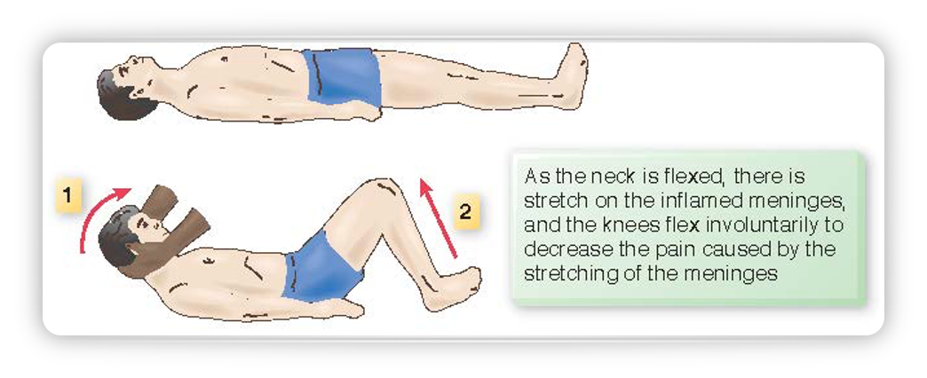 <p><span>as the neck is flexed, there is stretch on the inflamed meninges, and the knees flex involuntarily to decrease the pain caused by the stretching of the meninges</span></p>