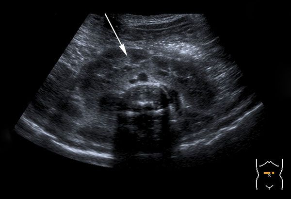 <p>Horseshoe Kidney:</p>