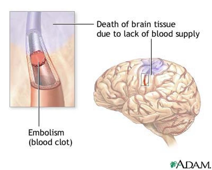<p>the sudden blockage of a blood vessel by an embolus</p>
