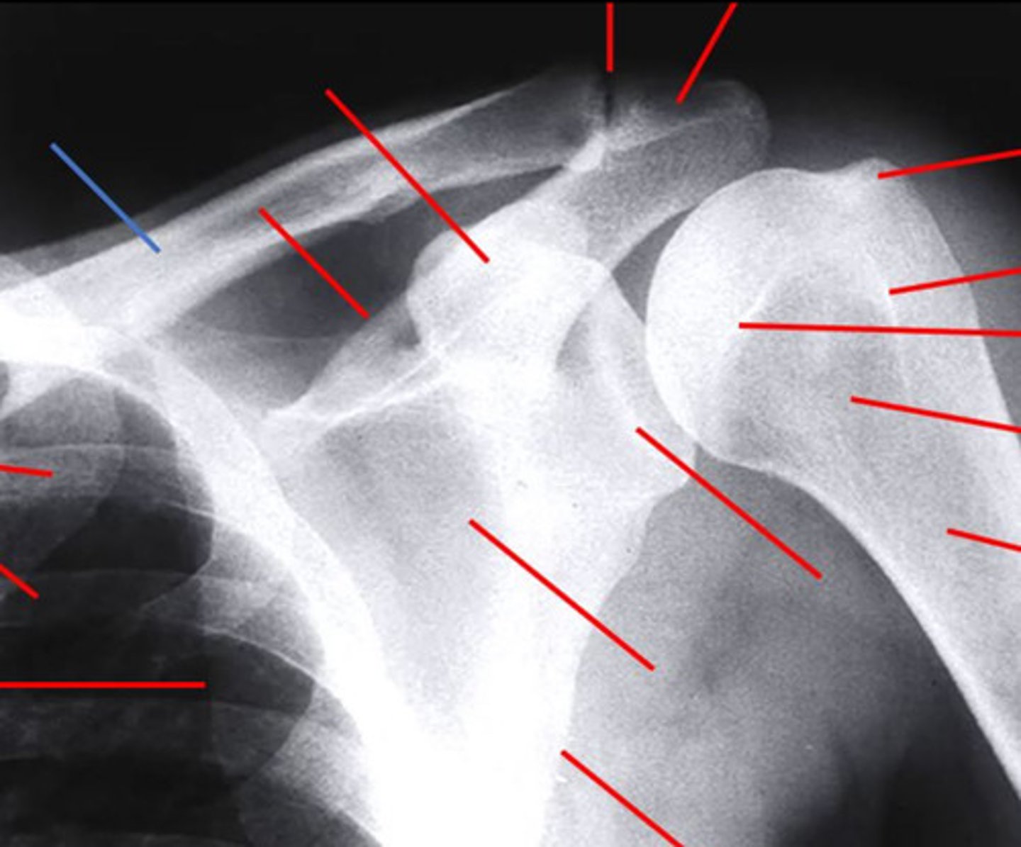 <p>clavicle</p><p>3 multiple choice options</p>