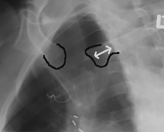 <p>OBL SC joint - is it over or under rotated?</p>