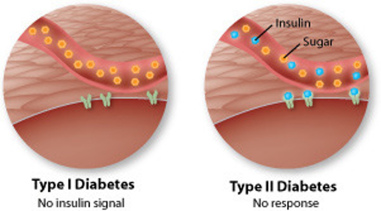 <p>Type 1:</p><p>- beta cells in islets of langerhans in pancreas produce 𝐢𝐧𝐬𝐮𝐟𝐟𝐢𝐜𝐢𝐞𝐧𝐭 𝐢𝐧𝐬𝐮𝐥𝐢𝐧</p><p>- develops in childhood due to an 𝐚𝐮𝐭𝐨𝐢𝐦𝐦𝐮𝐧𝐞 𝐫𝐞𝐬𝐩𝐨𝐧𝐬𝐞 which destroys beta calls</p><p>Type 2:</p><p>- the 𝐫𝐞𝐜𝐞𝐩𝐭𝐨𝐫𝐬 𝐨𝐧 𝐭𝐚𝐫𝐠𝐞𝐭 𝐜𝐞𝐥𝐥𝐬 𝐥𝐨𝐬𝐞 𝐫𝐞𝐬𝐩𝐨𝐧𝐬𝐢𝐯𝐞𝐧𝐞𝐬𝐬 to insulin</p><p>- this means fewer glucose transport proteins can be included, so less uptake of glucose and less glycogenesis</p><p>- occurs later in life with main risk factors being obesity, poor diet, lack of exercise and age</p>