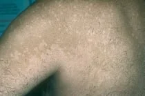 <p>Smaller lesions run together to form larger lesions. Example is tiena versicolor</p>