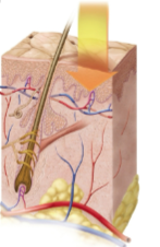 <p>First-degree burn</p>