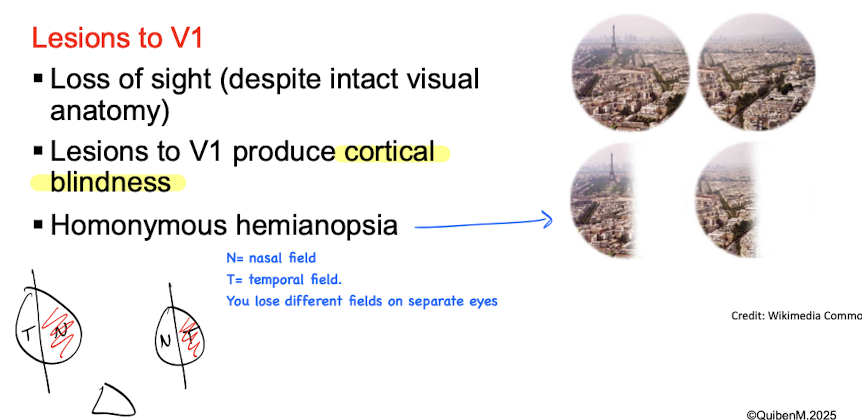 <ul><li><p>Loss of sight (despite intact visual anatomy) </p></li><li><p>Cortical blindness (complete loss of vision)</p></li><li><p>Homonymous hemianopsia (loss of vision on same side of both eyes. </p></li></ul><p></p>