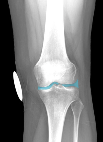 Location:
Knee
Description:
Space between articular surfaces of
distal end of femur, proximal end of
tibia, and posterior aspect of patella
Enclosed by fibrous joint capsule
Contains synovial fluid