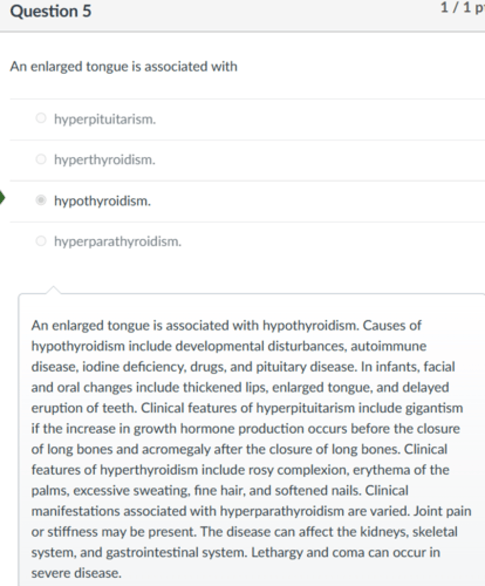 <p>hypothyroidism.</p><p>An enlarged tongue is associated with hypothyroidism. Causes of hypothyroidism include developmental disturbances, autoimmune disease, iodine deficiency, drugs, and pituitary disease. In infants, facial and oral changes include thickened lips, enlarged tongue, and delayed eruption of teeth. Clinical features of hyperpituitarism include gigantism if the increase in growth hormone production occurs before the closure of long bones and acromegaly after the closure of long bones. Clinical features of hyperthyroidism include rosy complexion, erythema of the palms, excessive sweating, fine hair, and softened nails. Clinical manifestations associated with hyperparathyroidism are varied. Joint pain or stiffness may be present. The disease can affect the kidneys, skeletal system, and gastrointestinal system. Lethargy and coma can occur in severe disease.</p>