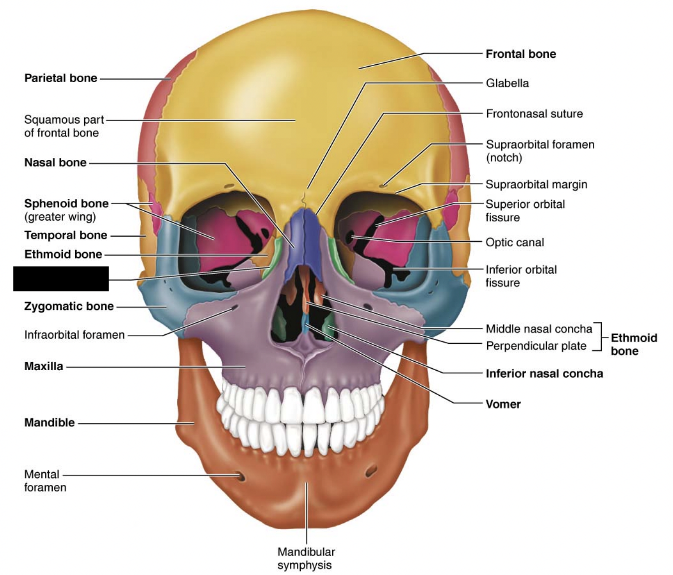What facial bones is this?