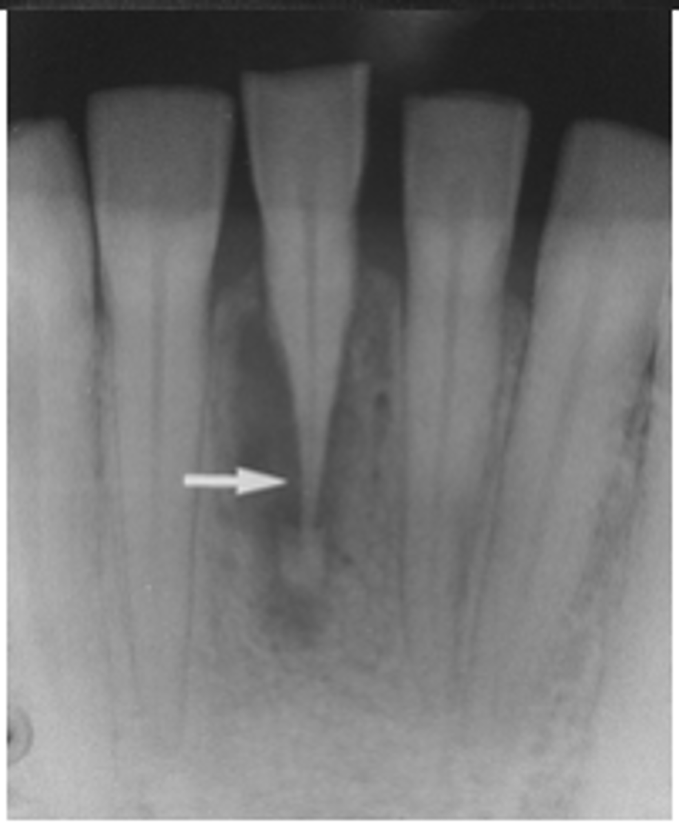 <p>Abnormal dentin condition-unknown etiology</p><p>-Resorption of the teeth externally</p>