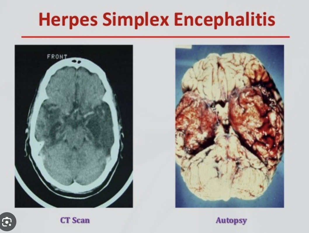 <p>Encephalitis (encephal-)</p>