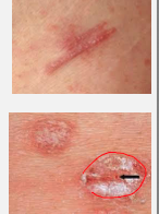 <ul><li><p><strong>Acanthosis:</strong> epidermal hyperplasia (thickened skin).</p></li><li><p><strong>Parakeratosis:</strong> stratum corneum retains nuclei.</p></li><li><p><strong>Stratum spinosum:</strong> thickened.</p></li><li><p><strong>Stratum granulosum:</strong> thinned or absent.</p></li><li><p><strong>Munro microabscesses:</strong> neutrophil clusters in stratum corneum.</p></li></ul><p></p>